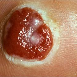 Example of skinCancerAndMelanomas